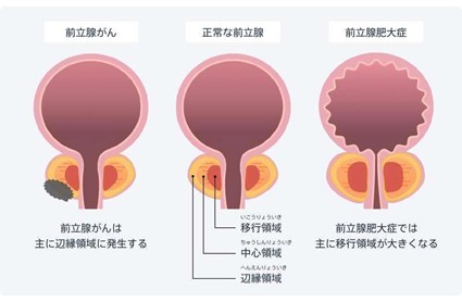 前立腺肥大症についてのアイキャッチ画像